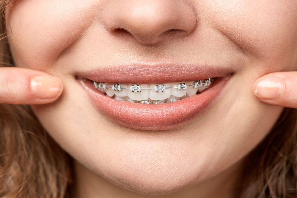 Braces for Adults & Teens