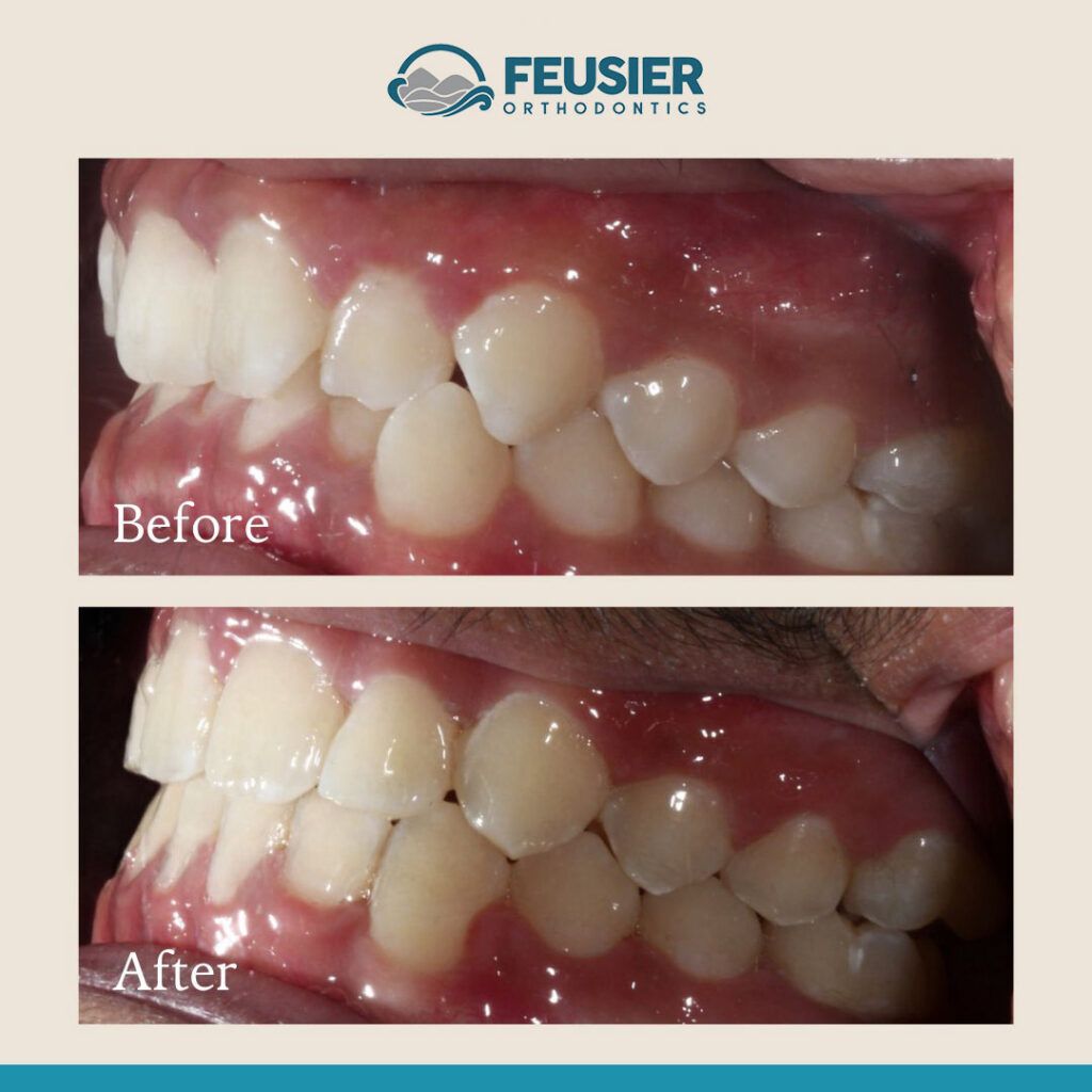 Smile Gallery Before and After Case-1
