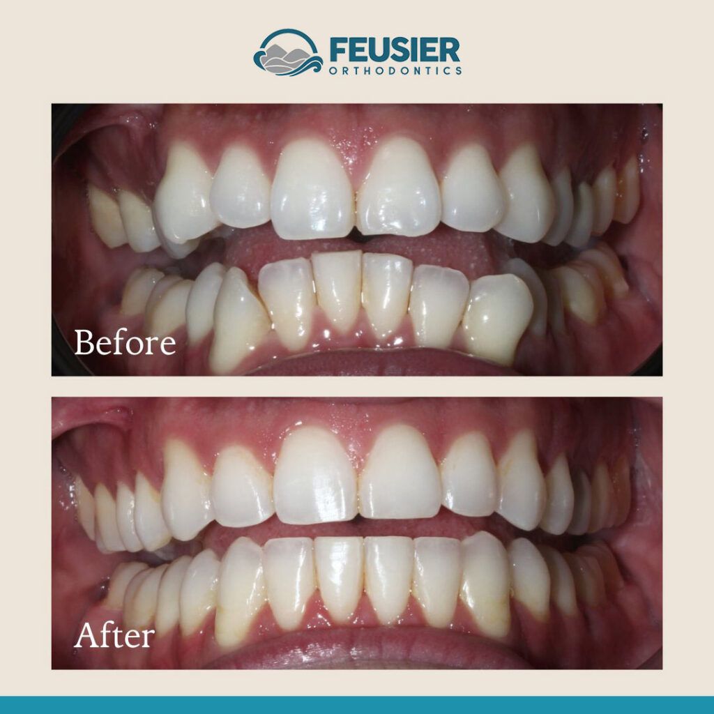 Smile Gallery Before and After Case-10