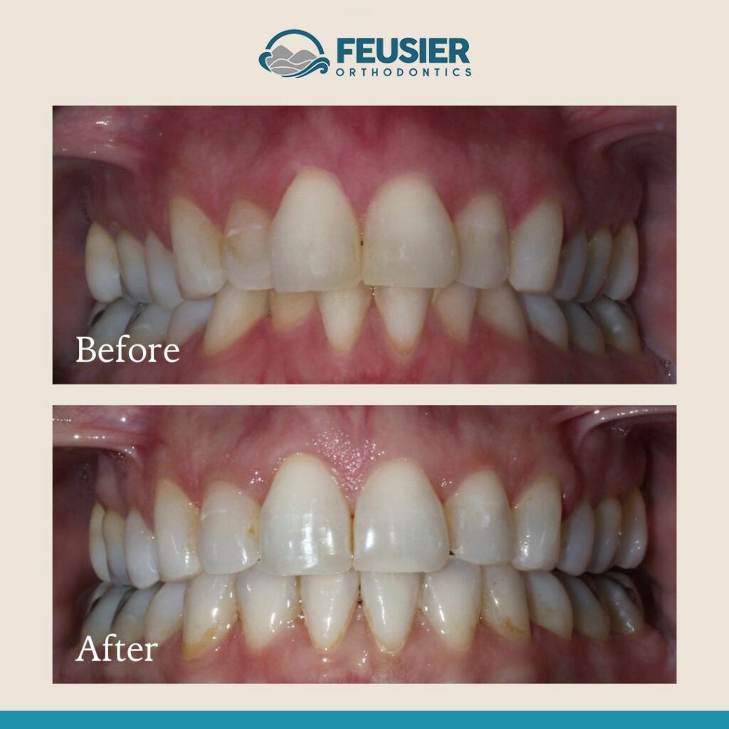 Smile Gallery Before and After Case-11