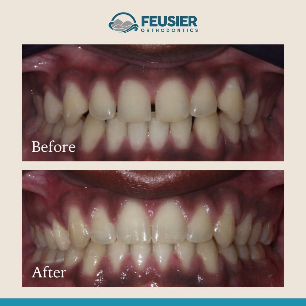 Smile Gallery Before and After Case-2