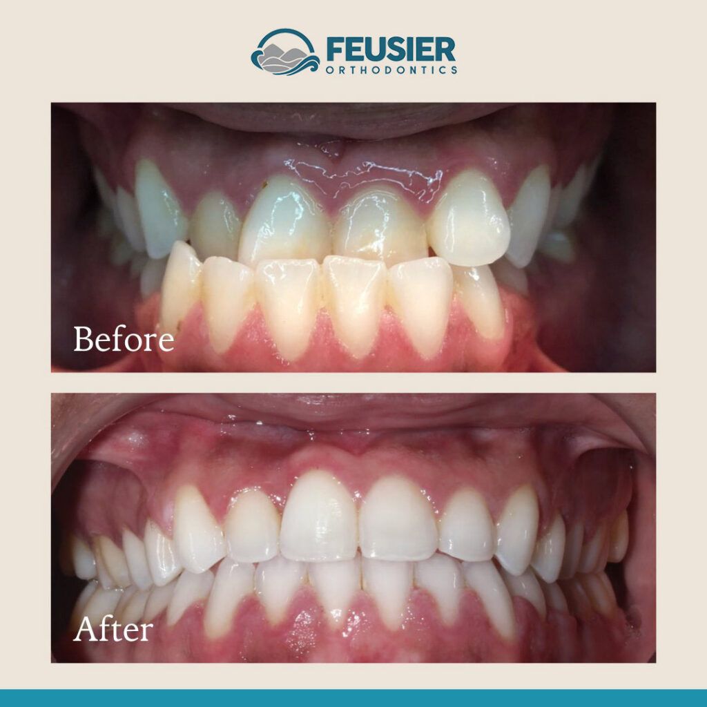 Smile Gallery Before and After Case-3