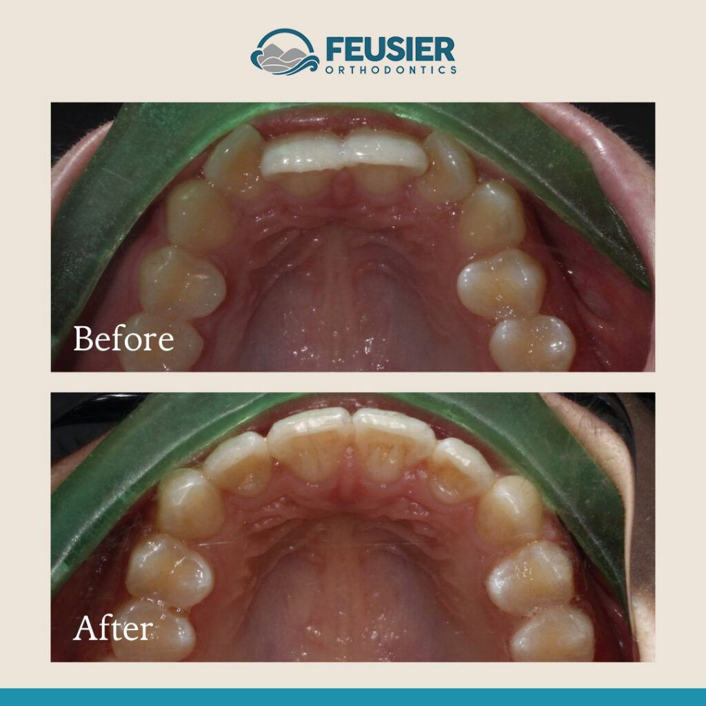 Smile Gallery Before and After Case-4
