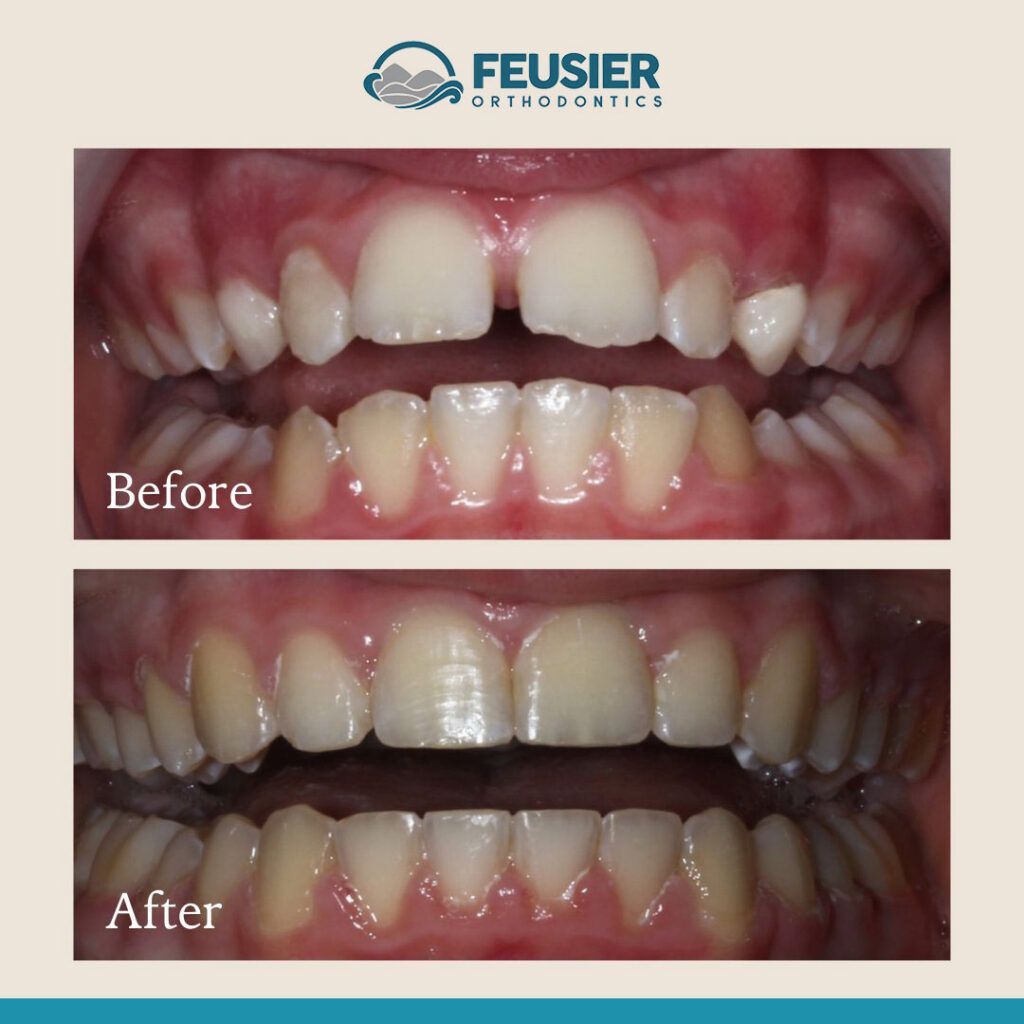 Smile Gallery Before and After Case-5