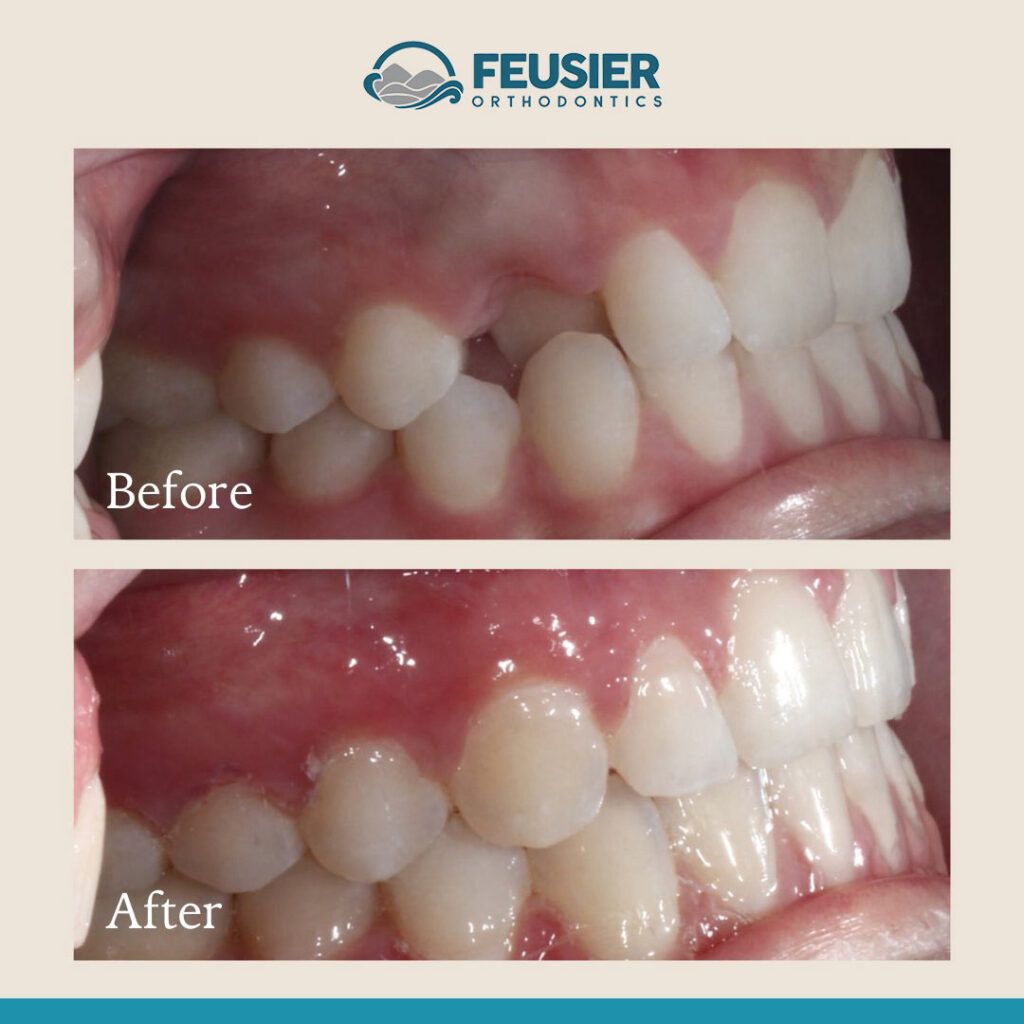 Smile Gallery Before and After Case-6