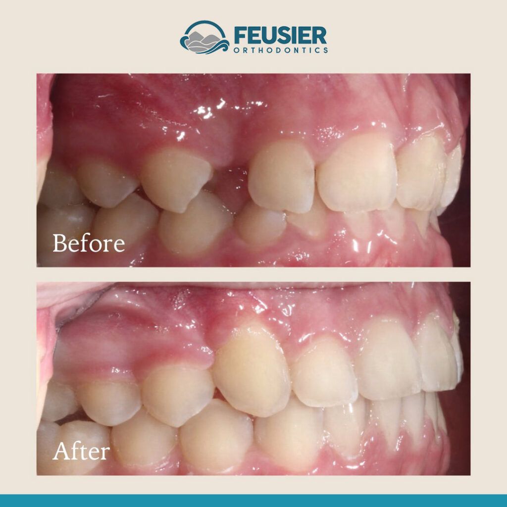 Smile Gallery Before and After Case-7