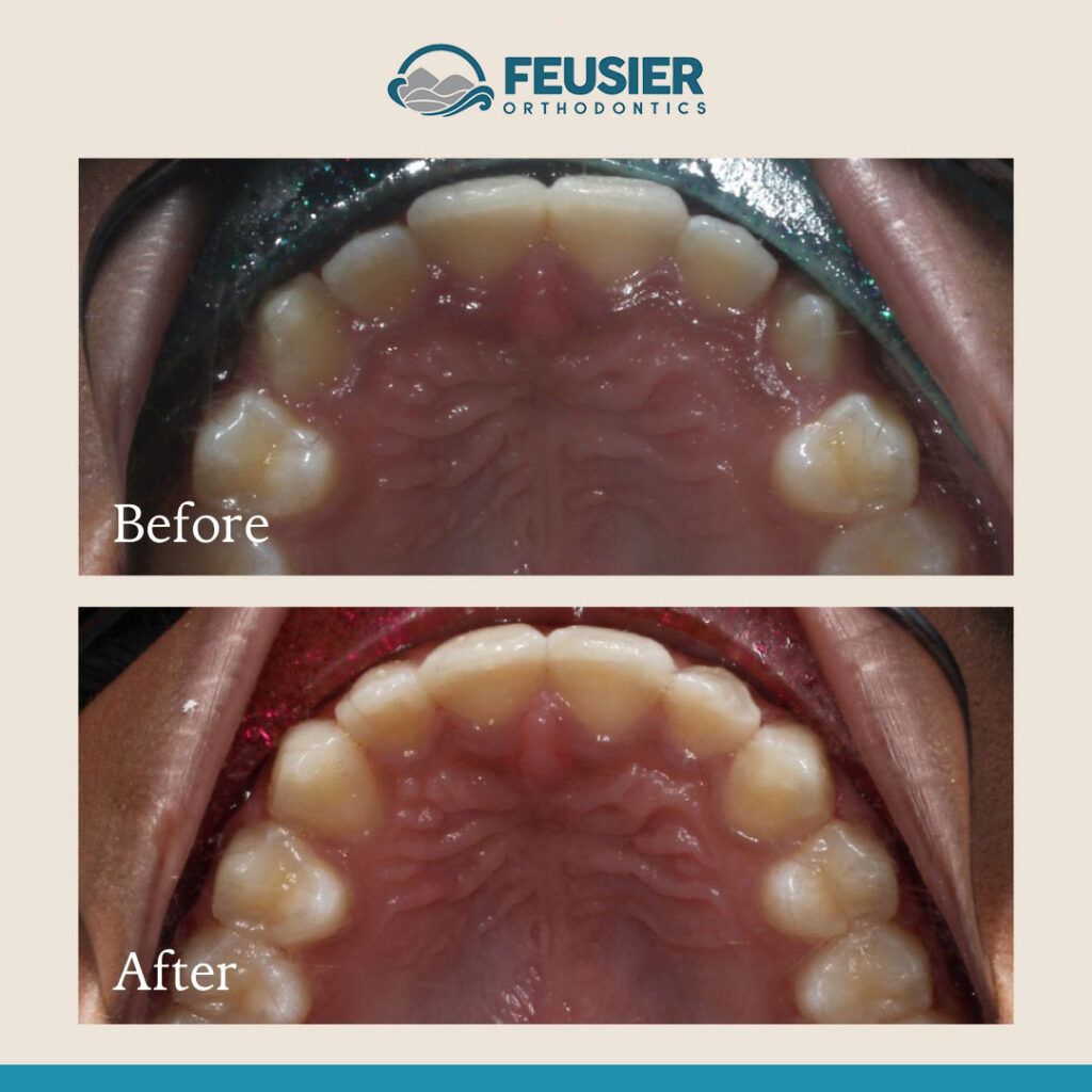 Smile Gallery Before and After Case-8