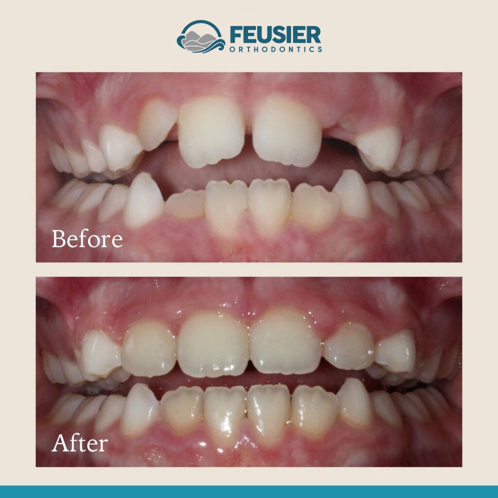 Smile Gallery Before and After Case-9
