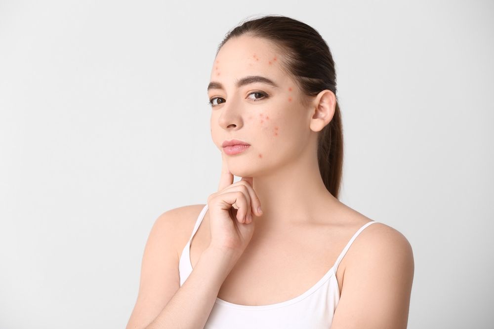Young woman with acne problem on light background