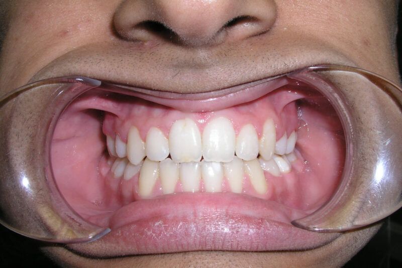 Adolescent Comprehensive Treatment After