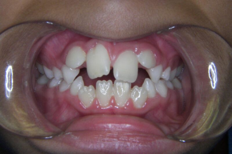 Adolescent Comprehensive Treatment Before