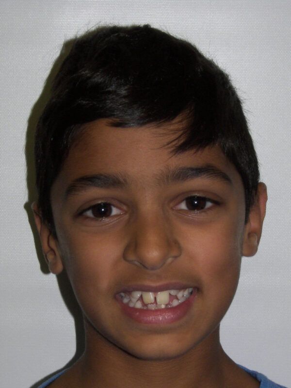 Adolescent Comprehensive Treatment Before