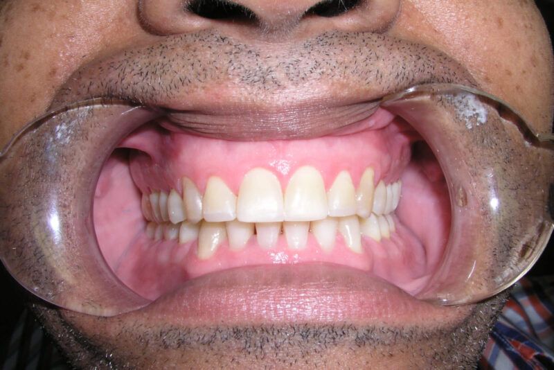 Adult Comprehensive Treatment After