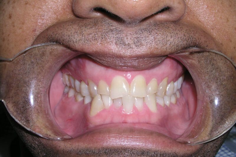 Adult Comprehensive Treatment Before