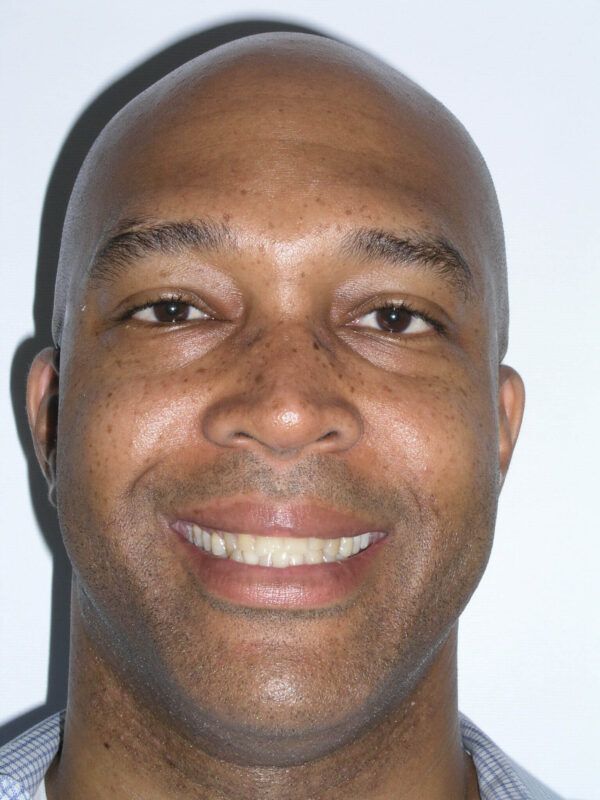 Adult Comprehensive Treatment Before