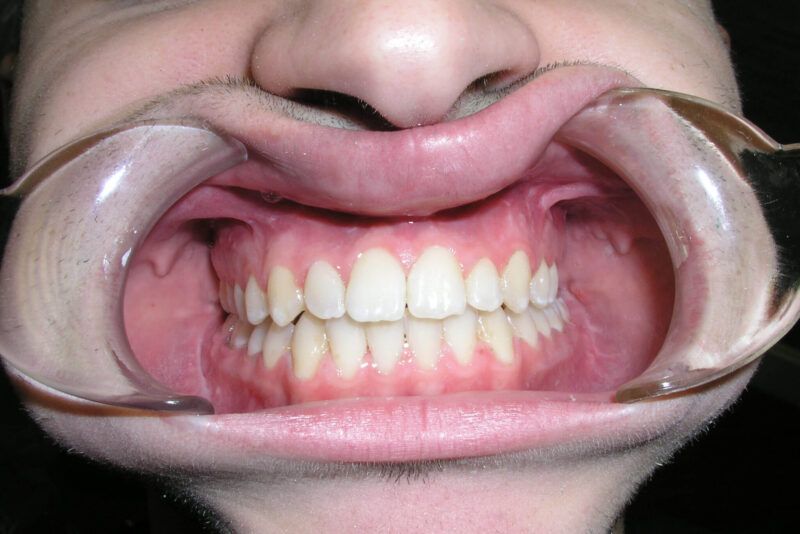 Adult Comprehensive Treatment with Orthognathic Surgery After