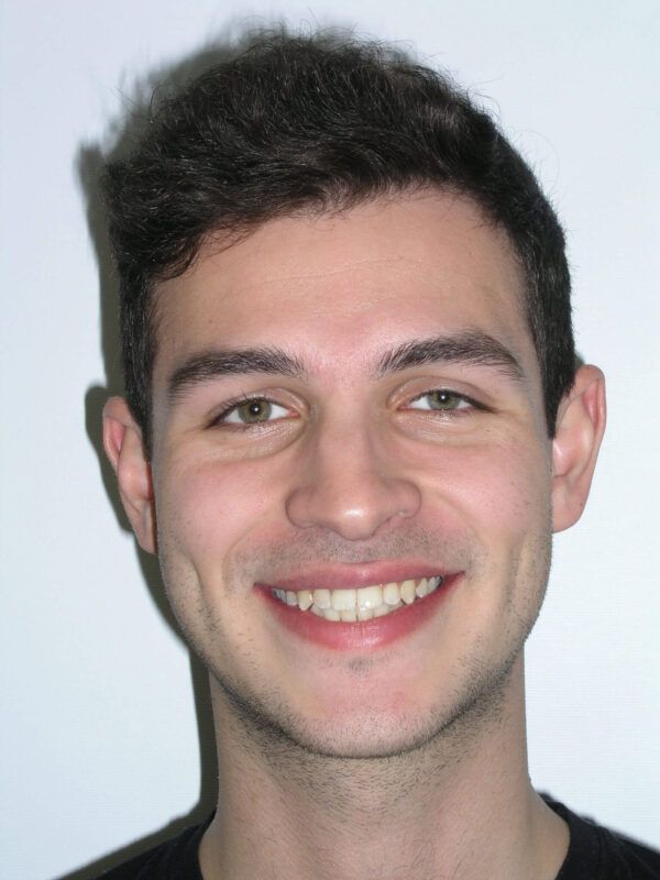 Adult Comprehensive Treatment with Orthognathic Surgery After
