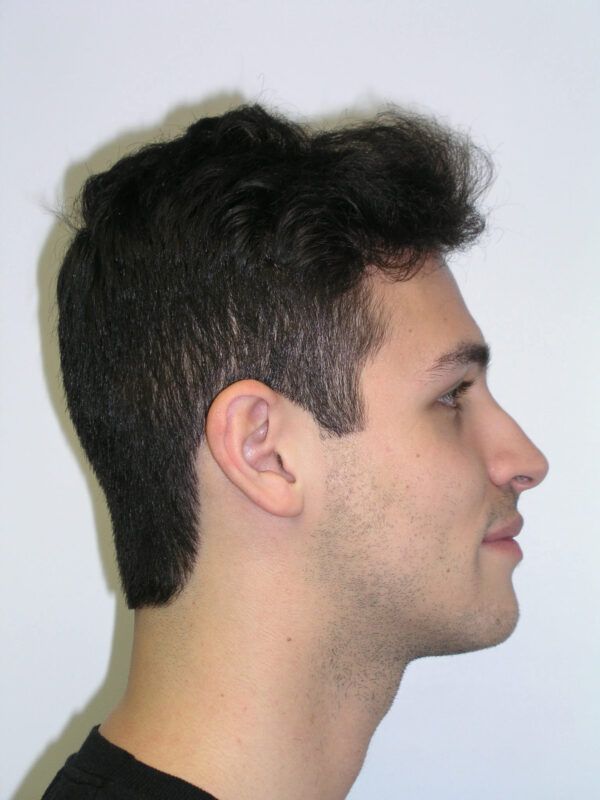 Adult Comprehensive Treatment with Orthognathic Surgery After