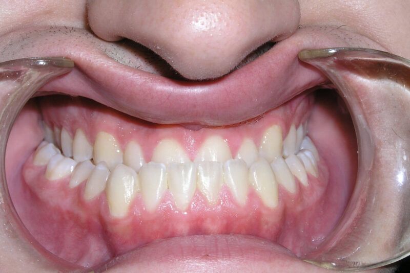 Adult Comprehensive Treatment with Orthognathic Surgery Before