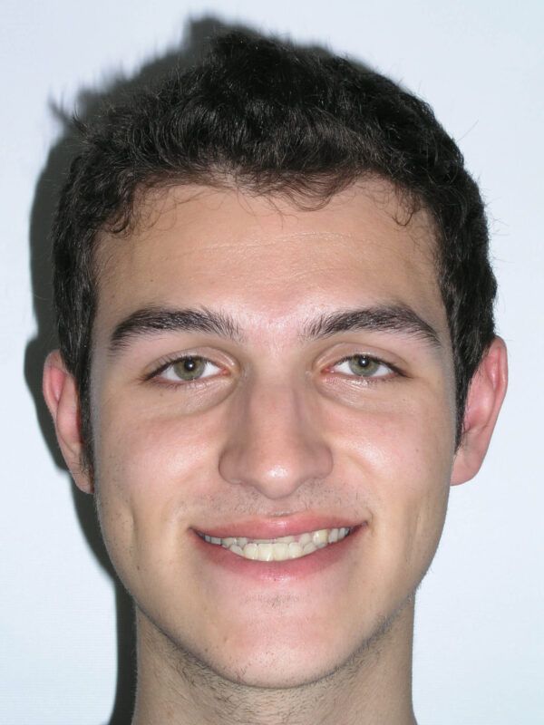 Adult Comprehensive Treatment with Orthognathic Surgery Before