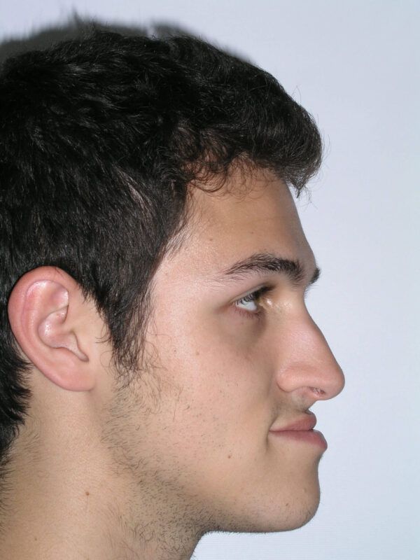 Adult Comprehensive Treatment with Orthognathic Surgery Before