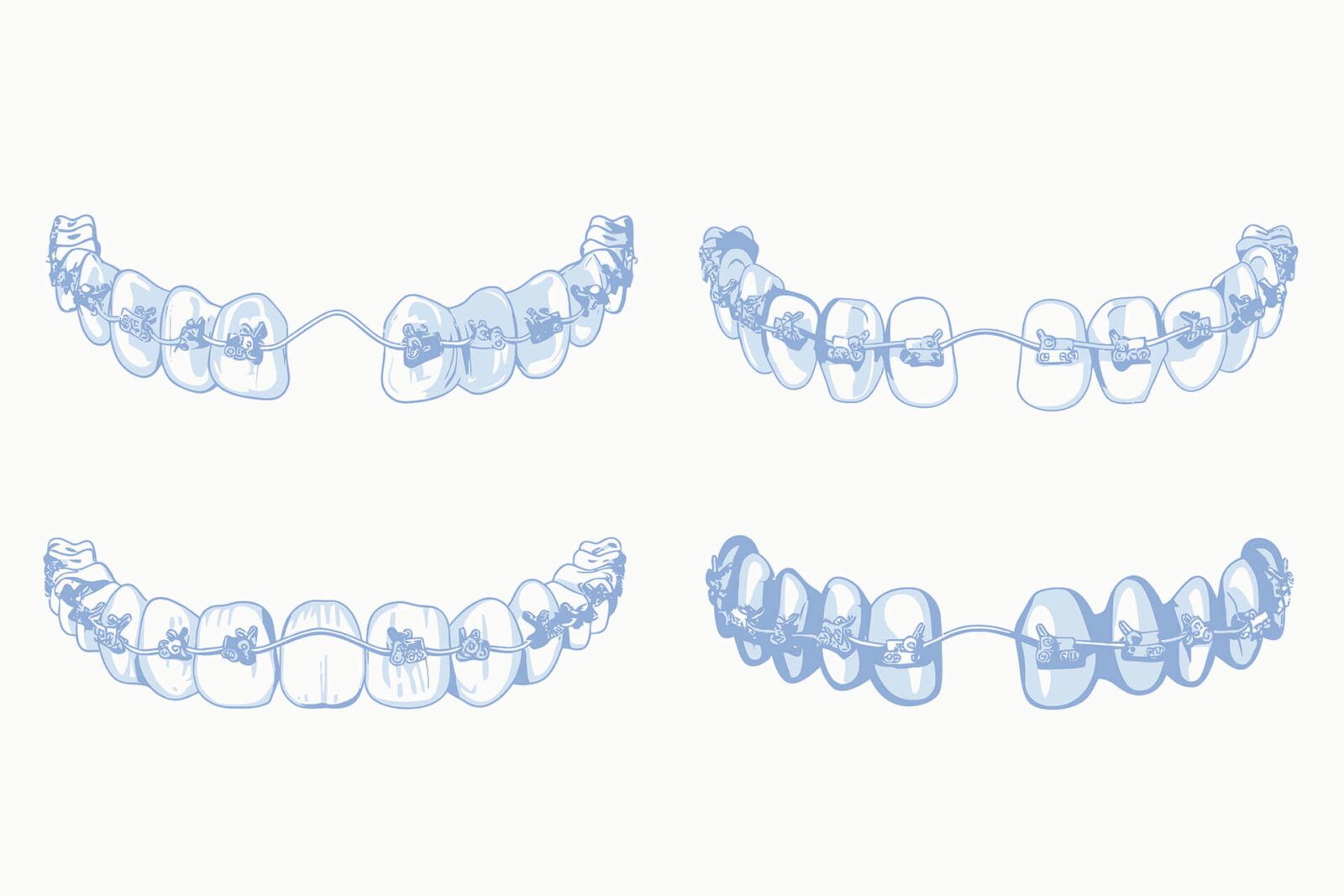 Four illustrations of orthodontic appliances