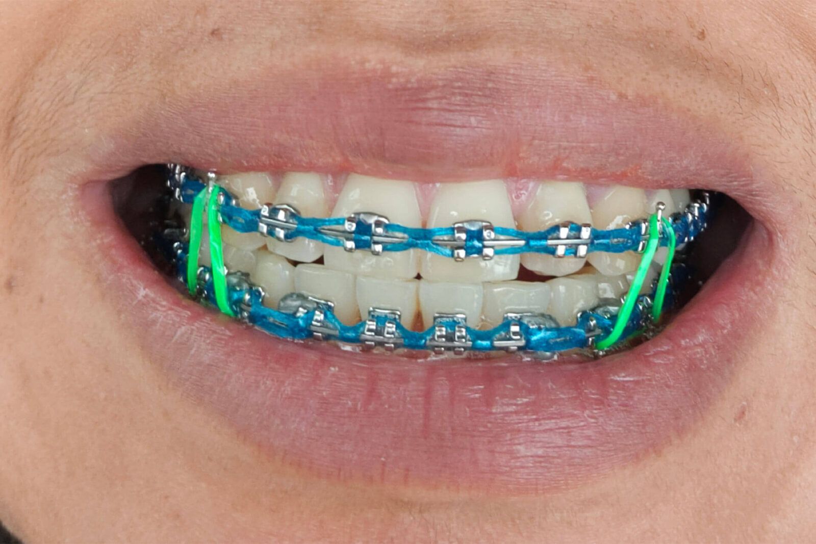 Teeth extraction braces with green rubber bands