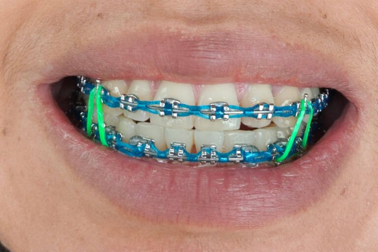 Teeth extraction braces with green rubber bands