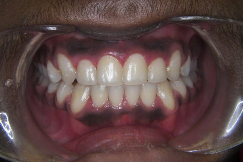 Open Bite Treatment After