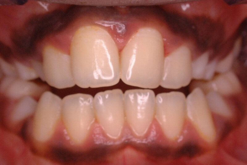 Open Bite Treatment Before