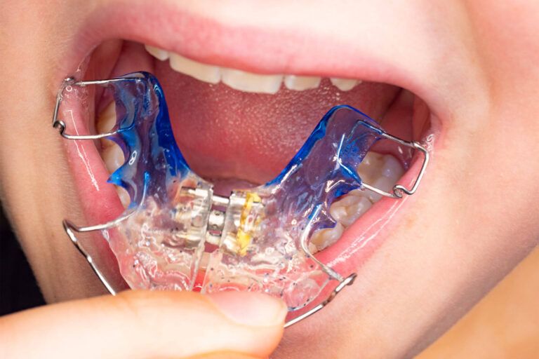 Patient photo of teeth with orthodontic braces