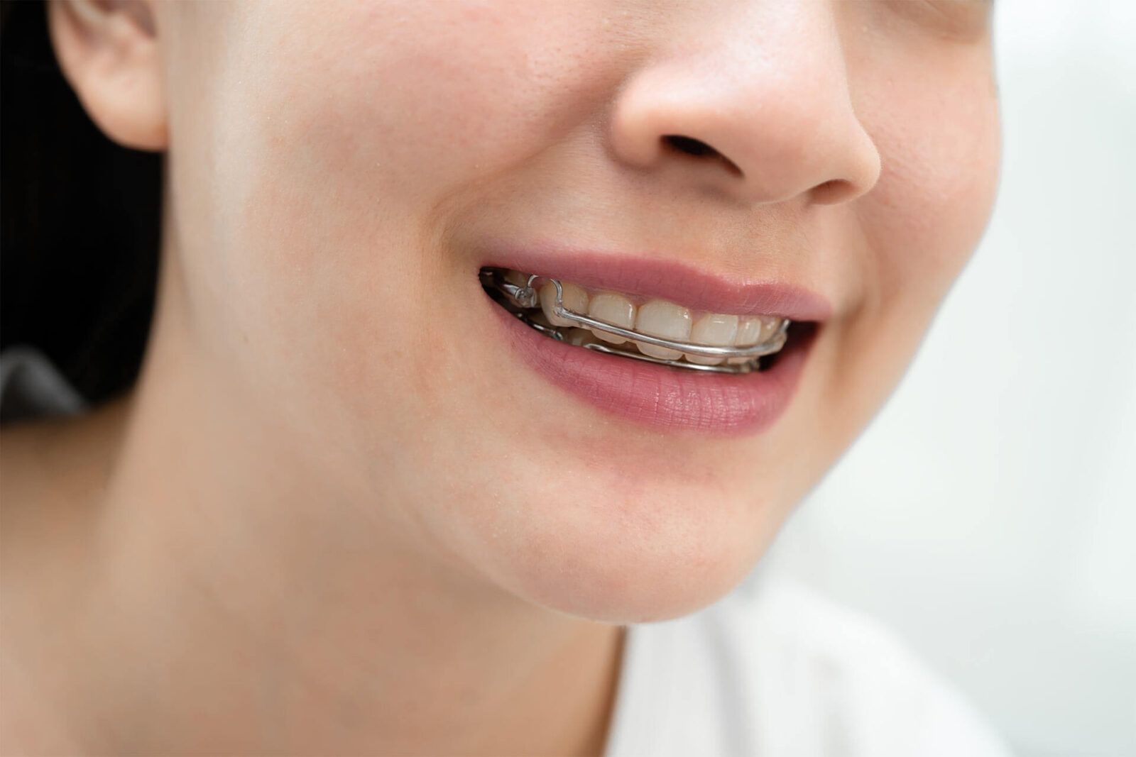 woman wearing Hawley retainer removable orthodontic appliance maintain position of teeth