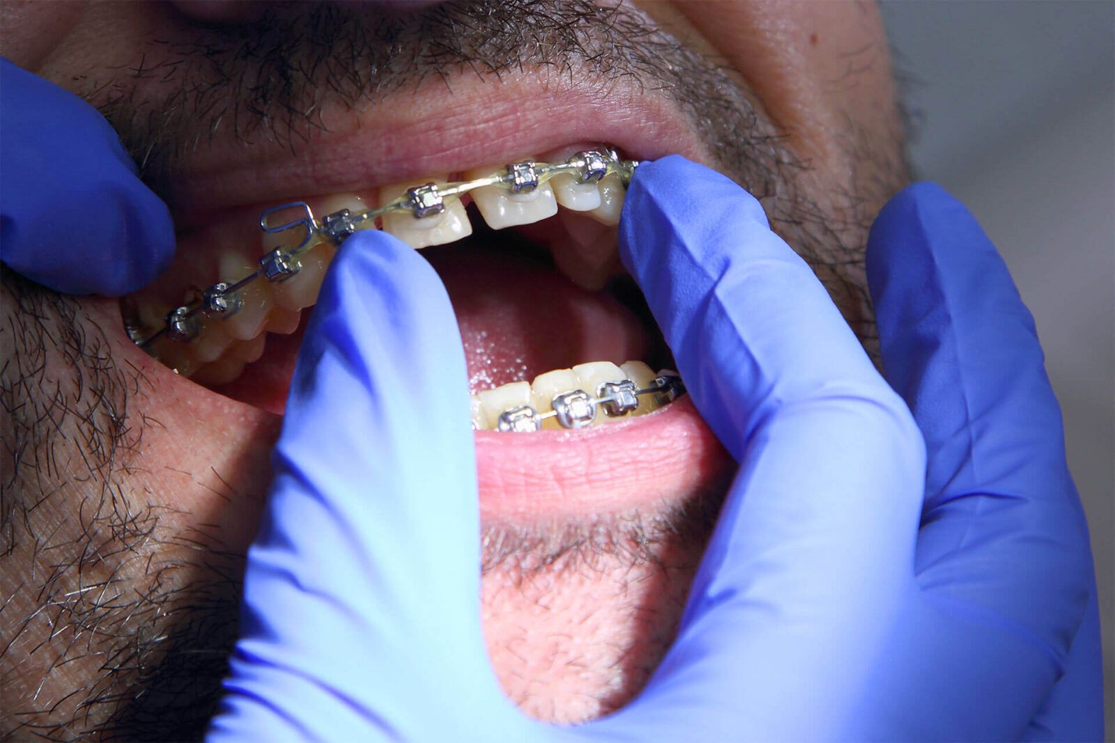 Installation of dental braces at the dental clinic