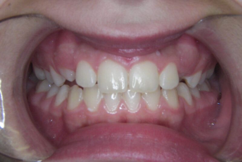 Phase 1 Treatment After