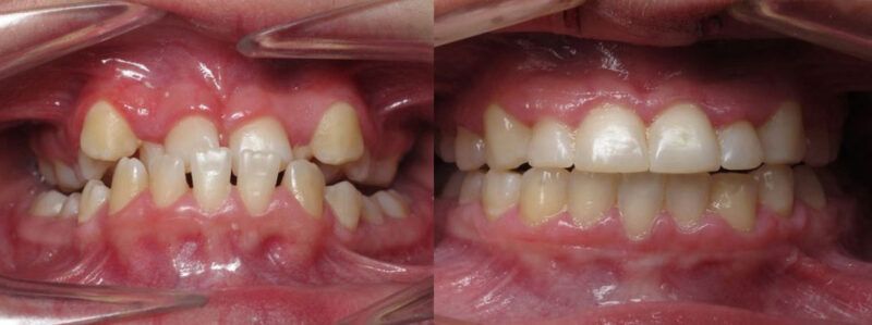 Alana Before and After 1