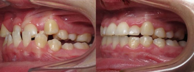 Alana Before and After 4