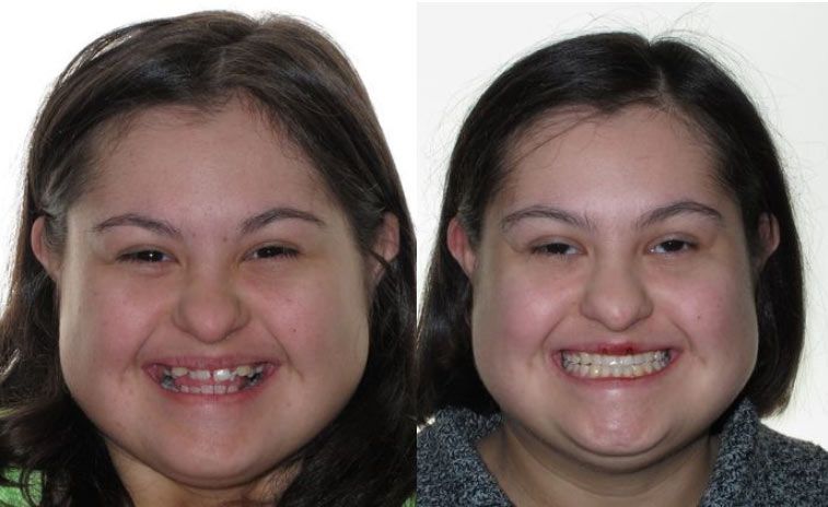 Alana Before and After 5