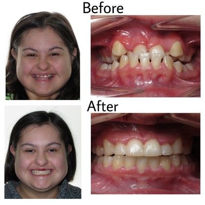 Alana Before and After