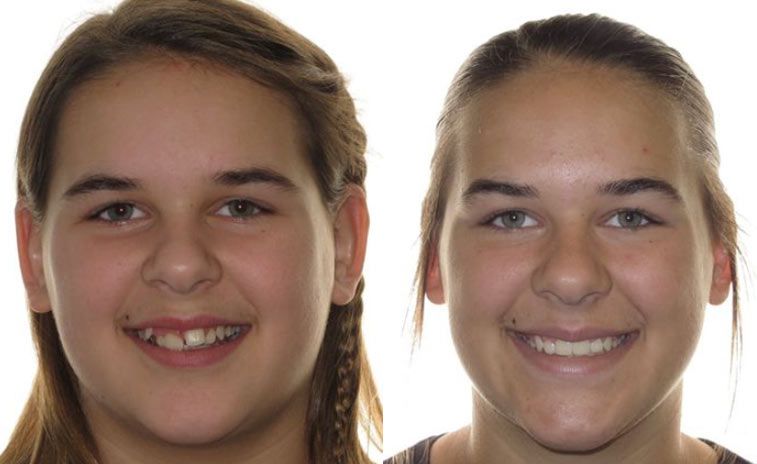 Briana Before and After 1