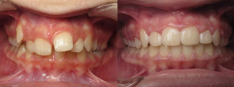Briana Before and After 2