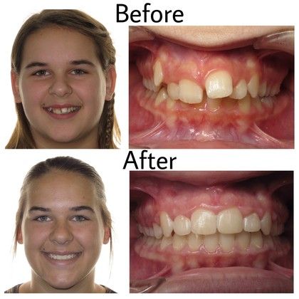 Briana Before and After