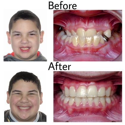 Cole Before and After