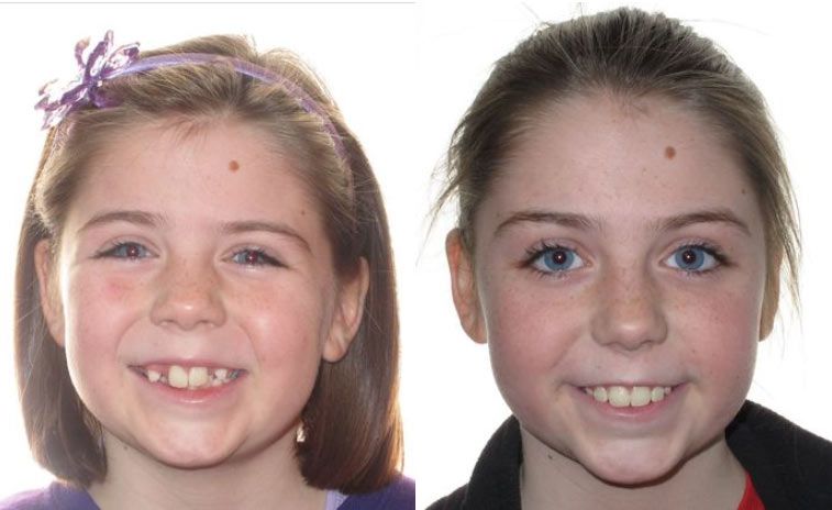 Hailey Before and After 1