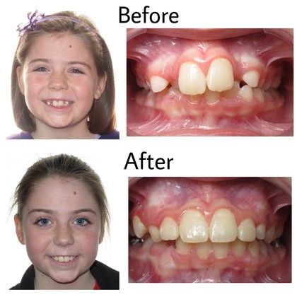 Hailey Before and After