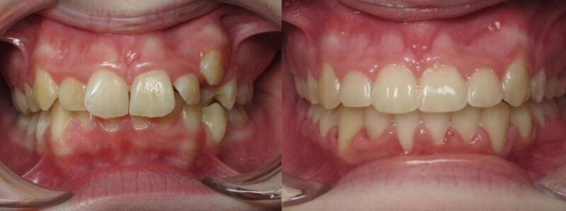 Jade Before and After 1