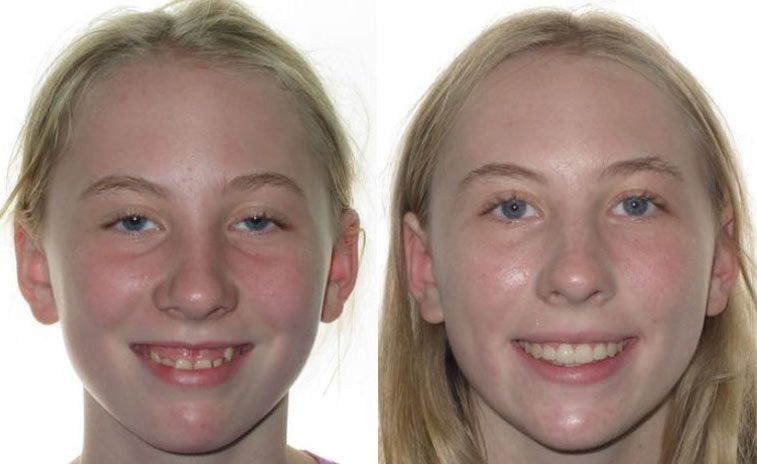 Jade Before and After 2
