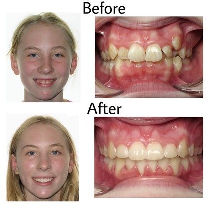 Jade Before and After