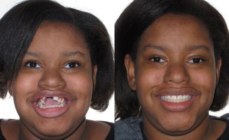 Jasmine Before and After 2