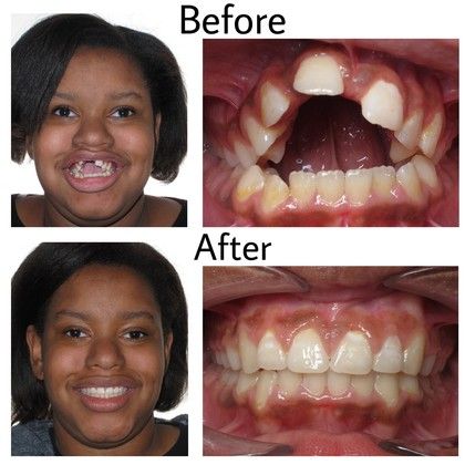 Jasmine Before and After