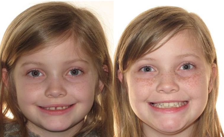 Julia Before and After 1